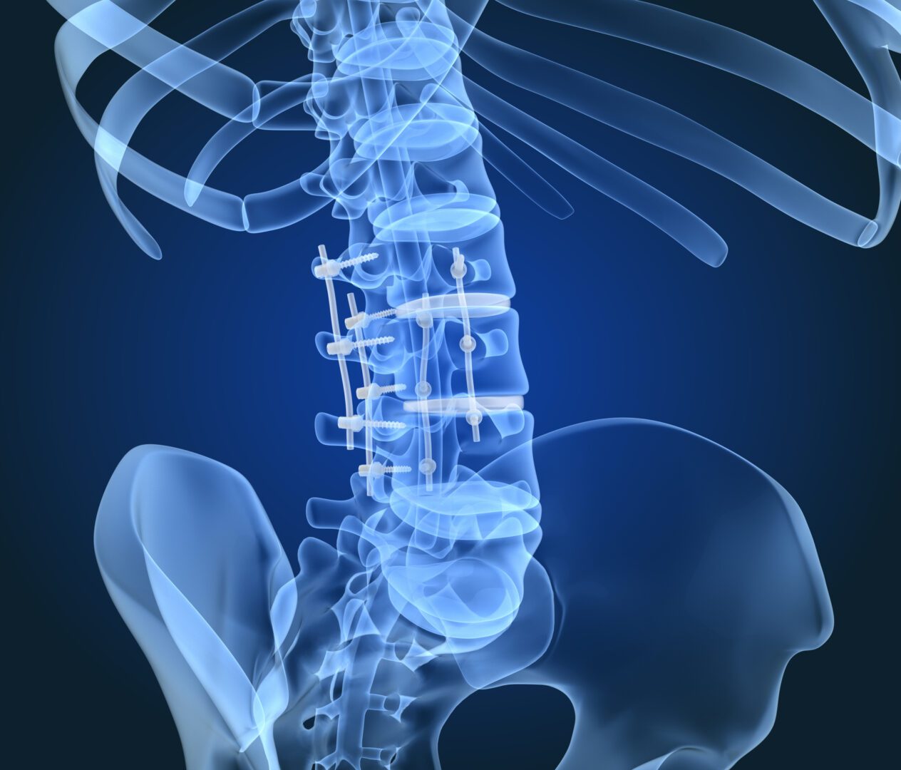 Spinal fixation system - titanium bracket. X-Ray 3D illustration