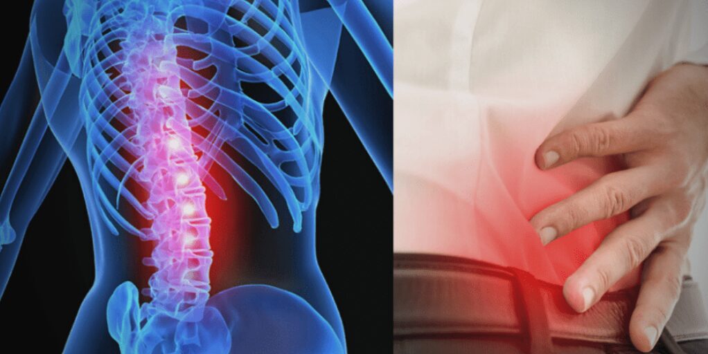 Spinal stenosis illustration showing inflamed spine next to person holding lower back in pain