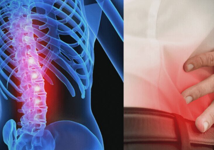 Spinal column X-ray highlighting pain areas alongside person holding lower back in discomfort
